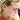 Hormonal acne